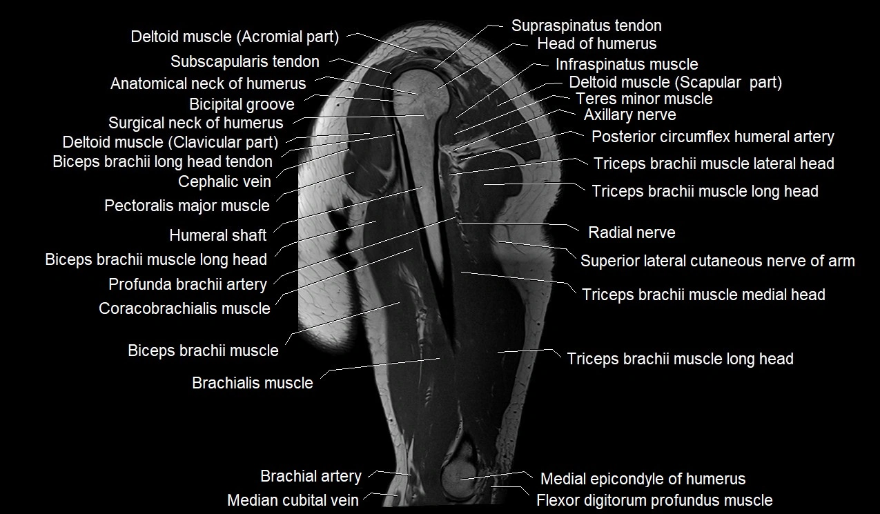 Upper arm (humerus ) saittal cross sectional anatomy 3T image 18.webp